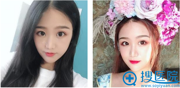 上海美莱整形医院做双眼皮怎么样?看吴海龙医生双眼皮真人案例 上海美莱整形医院做双眼皮怎么样?看吴海龙医生双眼皮真人案例