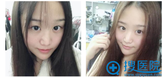 上海美莱做双眼皮怎么样?看吴海龙医生双眼皮案例效果让你惊艳
