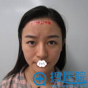 妈妈说成都素美杨迪为我自体脂肪丰额头+苹果肌+太阳穴效果挺好