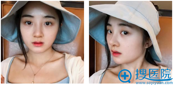 不知不觉找华山连天美<!--<i data=20240710 data-id=16495></i>-->做完自体耳软骨隆鼻九天了 不知不觉找华山连天美<!--<i data=20240710 data-id=16495></i>-->做完自体耳软骨隆鼻九天了