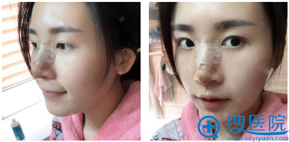 我要为给我做鼻综合隆鼻手术的重庆军美章小平医生点个赞