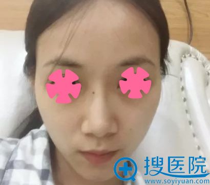 不了解无锡丽都整形怎么样的美眉 请看孙守县面部脂肪填充案例