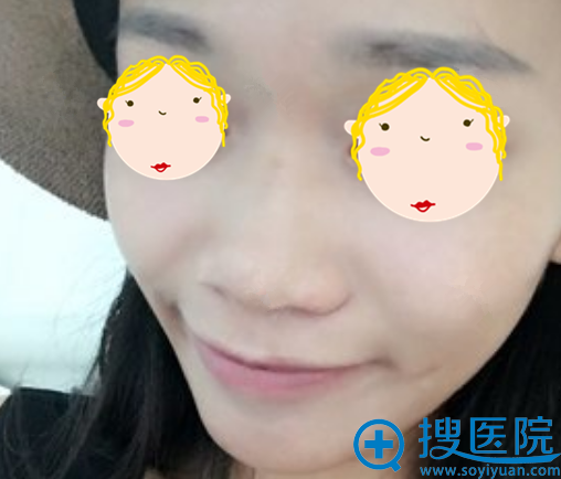 为了和青岛华韩赵煜楠给我做的双眼皮配套,我又做了耳软骨隆鼻