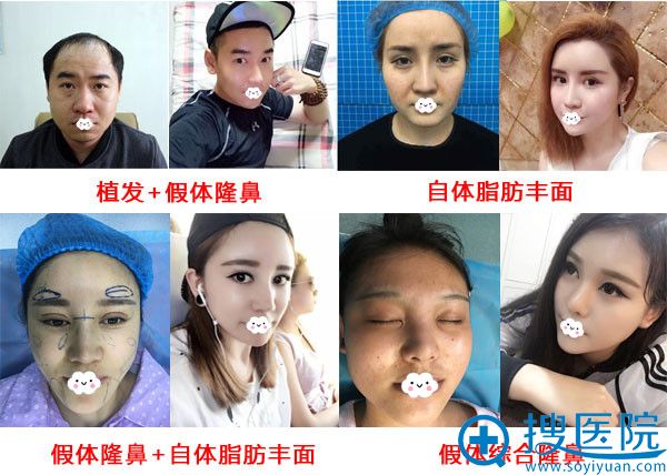大连达美元辰整形效果前后对比 大连达美元辰整形效果前后对比