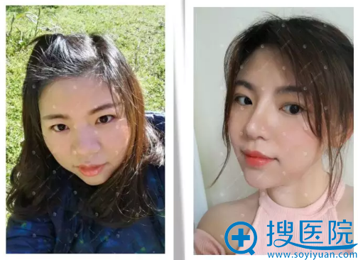 武汉美立方胡江伟鼻综合隆鼻案例前后对比图 武汉美立方胡江伟鼻综合隆鼻案例前后对比图