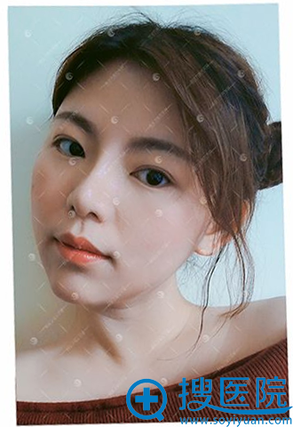找武汉美立方胡江伟做完鼻综合隆鼻术后三周效果图 找武汉美立方胡江伟做完鼻综合隆鼻术后三周效果图