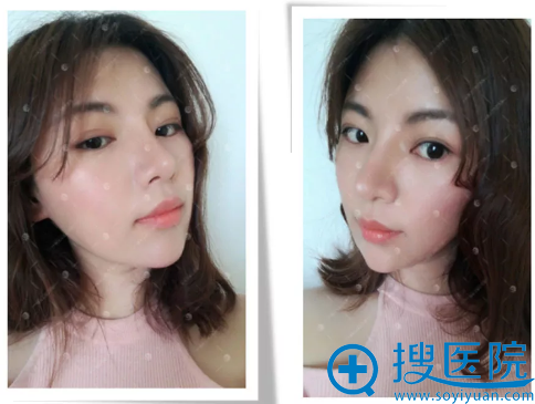 武汉美立方胡江伟鼻综合隆鼻术后自拍 武汉美立方胡江伟鼻综合隆鼻术后自拍