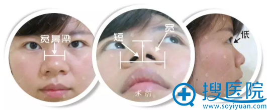 面诊了樊辉华和胡江伟医生选择武汉美立方胡江伟做了鼻综合隆鼻