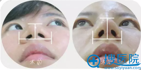 武汉美立方胡江伟鼻综合隆鼻术后7天拆线图片 武汉美立方胡江伟鼻综合隆鼻术后7天拆线图片
