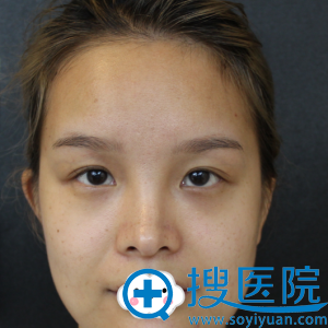 深圳贝漾美天曹思佳双眼皮案例 深圳贝漾美天曹思佳双眼皮案例