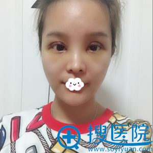 深圳贝漾美天曹思佳眼部综合整形案例 深圳贝漾美天曹思佳眼部综合整形案例