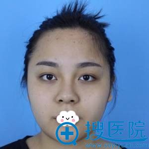 为了暑假游泳能够素颜到深圳妍熙做了假体隆鼻+鼻尖整形