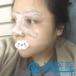 深圳妍熙陈桂飞假体隆鼻综合整形案例 深圳妍熙陈桂飞假体隆鼻综合整形案例