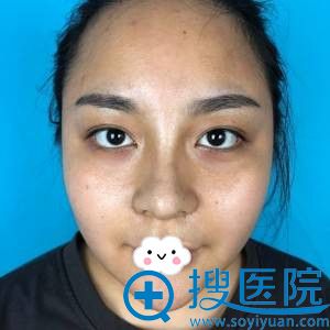 深圳妍熙陈桂飞假体鼻综合效果 深圳妍熙陈桂飞假体鼻综合效果