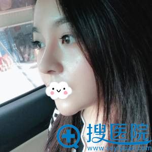 深圳妍熙假体隆鼻+垫鼻尖整形效果 深圳妍熙假体隆鼻+垫鼻尖整形效果