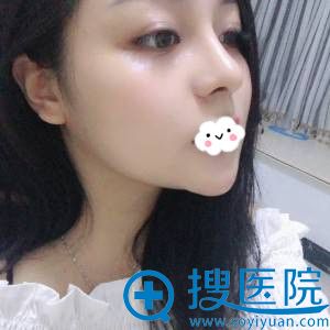 深圳妍熙陈桂飞假体隆鼻+耳软骨垫鼻尖案例 深圳妍熙陈桂飞假体隆鼻+耳软骨垫鼻尖案例