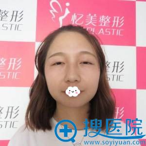 <!--<i data=20240710 data-id=9715></i>-->双眼皮真人案例 <!--<i data=20240710 data-id=9715></i>-->双眼皮真人案例