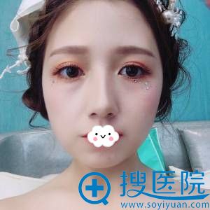 <!--<i data=20240710 data-id=9715></i>-->双眼皮+开眼角案例 <!--<i data=20240710 data-id=9715></i>-->双眼皮+开眼角案例