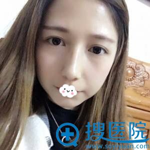 <!--<i data=20240710 data-id=9715></i>-->双眼皮案例 <!--<i data=20240710 data-id=9715></i>-->双眼皮案例