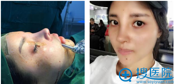 上海华美叶丽萍做的鼻子术后第七天效果图 上海华美叶丽萍做的鼻子术后第七天效果图