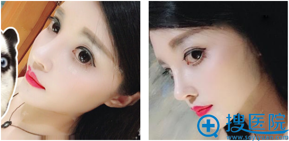 上海华美叶丽萍鼻综合隆鼻术后二十天 上海华美叶丽萍鼻综合隆鼻术后二十天