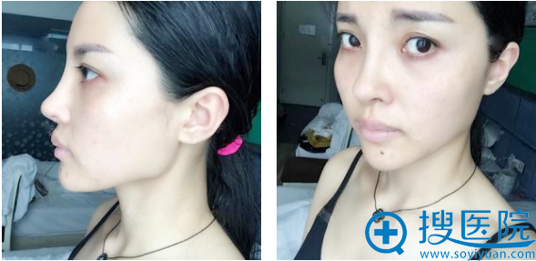 找上海华美叶丽萍做鼻综合隆鼻子一个月了 找上海华美叶丽萍做鼻综合隆鼻子一个月了