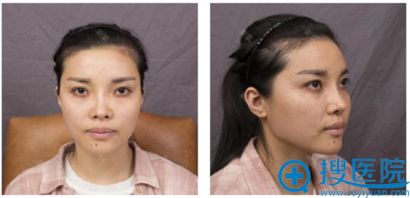 看朋友半年前找上海华美叶丽萍做的鼻子不错我也来做了个隆鼻