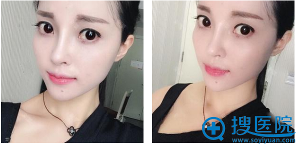 上海华美叶丽萍做的鼻综合隆鼻子案例术后三个月图片 上海华美叶丽萍做的鼻综合隆鼻子案例术后三个月图片