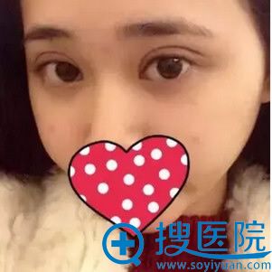 茜茜做双眼皮7天拆线效果 茜茜做双眼皮7天拆线效果