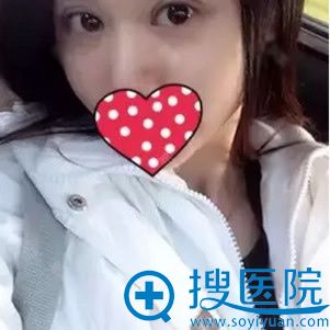 茜茜在芜湖伊莱美做双眼皮16天效果 茜茜在芜湖伊莱美做双眼皮16天效果