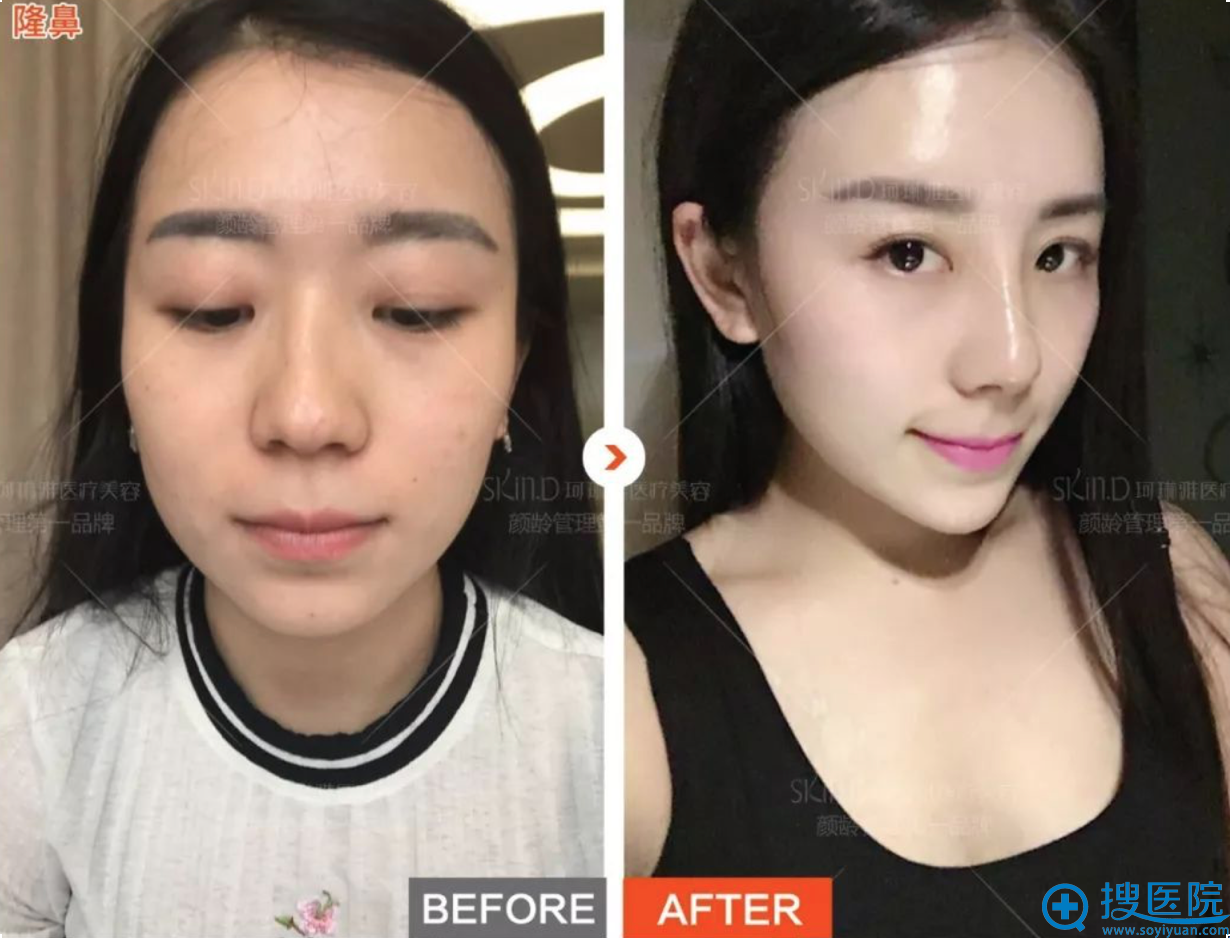 重庆珂琳雅韦小勇隆鼻案例分享:你和美女只差一个鼻子的距离