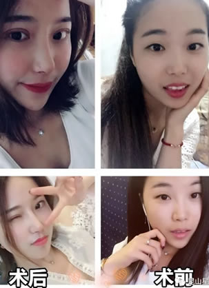 昆山星范张金辉院长做隆鼻怎么样?假体隆鼻手术案例20天效果