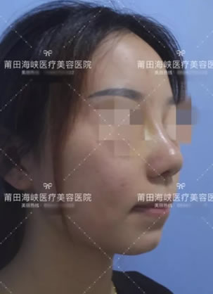 在莆田海峡陈雄主任这里做假体隆鼻手术后7天恢复效果图