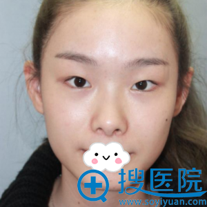 我闭眼无痕的双眼皮效果是深圳希思李俊眼综合达到的