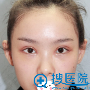 <!--<i data=20240710 data-id=12503></i>-->李俊全切双眼皮术后效果 <!--<i data=20240710 data-id=12503></i>-->李俊全切双眼皮术后效果