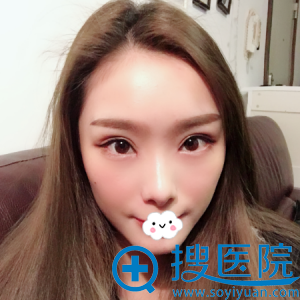 <!--<i data=20240710 data-id=12503></i>-->李俊双眼皮+开眼角真实效果 <!--<i data=20240710 data-id=12503></i>-->李俊双眼皮+开眼角真实效果