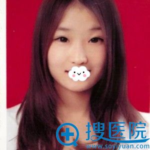 武汉华美付国友院长实力真不错 为我肋软骨综合隆鼻不仅变气质
