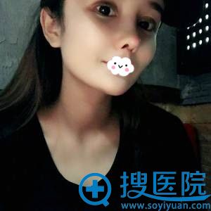 <!--<i data=20240710 data-id=11795></i>-->肋软骨隆鼻术后效果 <!--<i data=20240710 data-id=11795></i>-->肋软骨隆鼻术后效果