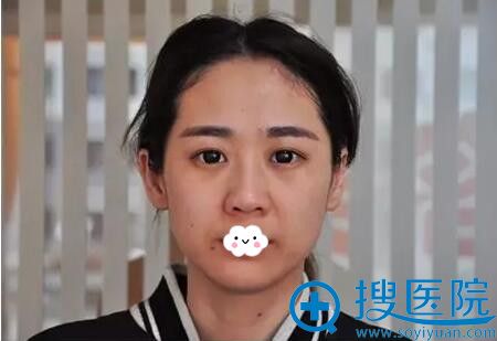 佛系美妞眼综合案例反馈:大连李鲁阳做眼整形效果不错