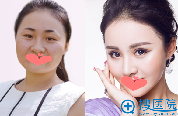 <!--<i data=20240710 data-id=12077></i>-->真人整形案例对比图 <!--<i data=20240710 data-id=12077></i>-->真人整形案例对比图