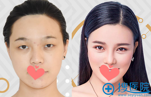 <!--<i data=20240710 data-id=12077></i>-->整形美容医院眼鼻部整形案例 <!--<i data=20240710 data-id=12077></i>-->整形美容医院眼鼻部整形案例