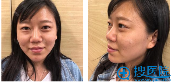 快看我去上海美莱和华美面诊后找杨亚益做的双眼皮和鼻子好看吗