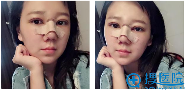 上海华美<!--<i data=20240710 data-id=16301></i>-->双眼皮隆鼻术后七天效果图 上海华美<!--<i data=20240710 data-id=16301></i>-->双眼皮隆鼻术后七天效果图