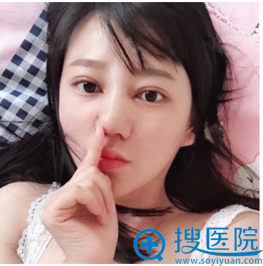 来上海华美找<!--<i data=20240710 data-id=16301></i>-->做眼睛和鼻子术后一个月恢复照片 来上海华美找<!--<i data=20240710 data-id=16301></i>-->做眼睛和鼻子术后一个月恢复照片