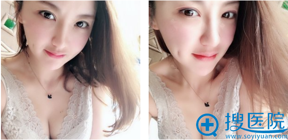 西安韩媚王仁根自体脂肪隆胸术后第五天恢复情况 西安韩媚王仁根自体脂肪隆胸术后第五天恢复情况
