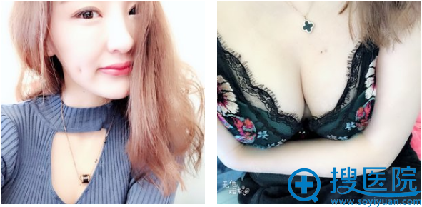 西安韩媚王仁根自体脂肪隆胸术后十天生活照 西安韩媚王仁根自体脂肪隆胸术后十天生活照