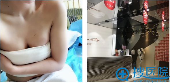 在西安韩媚整形医院找王仁根做完自体脂肪隆胸天 在西安韩媚整形医院找王仁根做完自体脂肪隆胸天