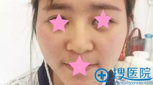 无锡哪家整形医院隆鼻好?看了案例及价格后我还是去了无锡尚美