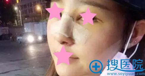 膨体假体隆鼻当天 膨体假体隆鼻当天