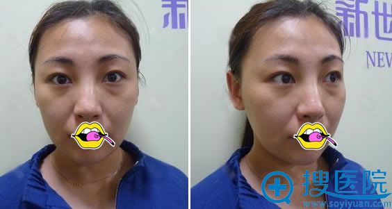 做双眼皮手术前内双照片 做双眼皮手术前内双照片